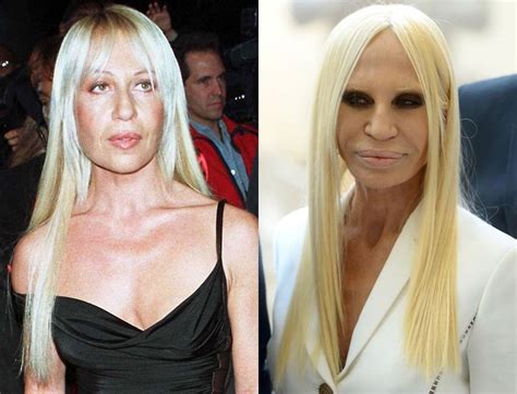 donatella versace nata|donatella versace before and after surgery.